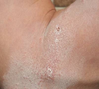 dermatitis caused by english ivy